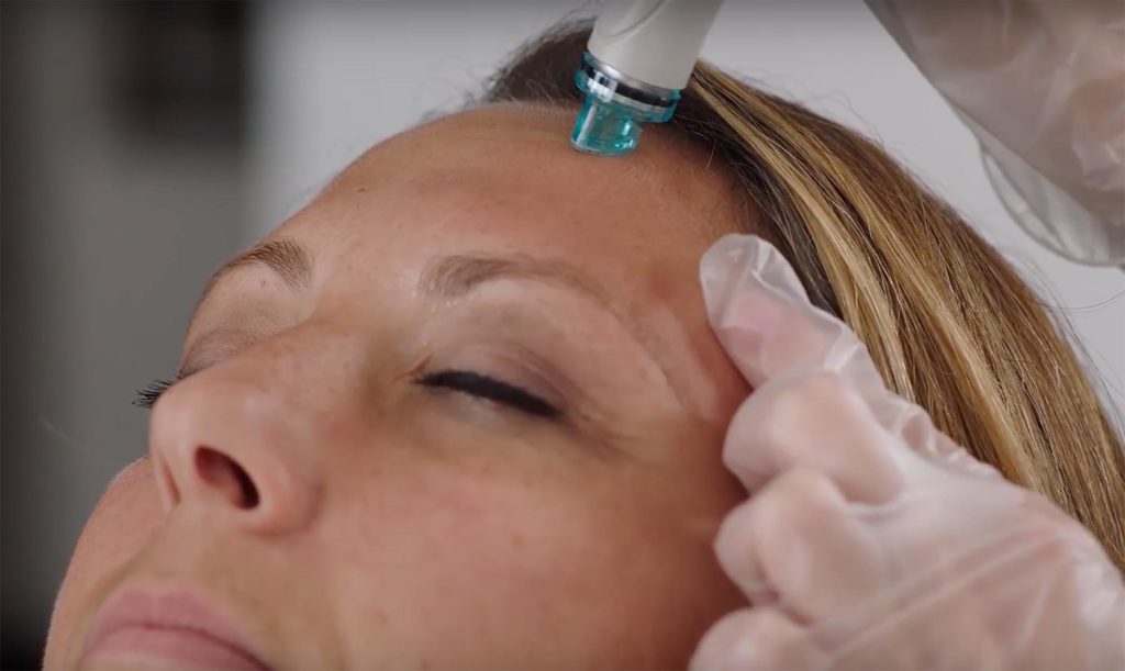 Hydrafacial is a soothing and non-irritating, effective anti-aging treatment