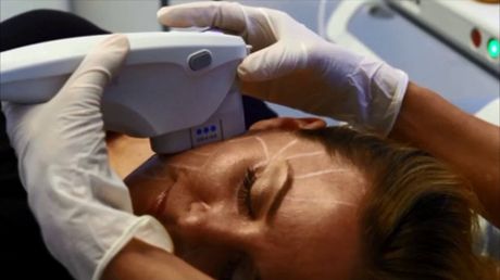 Ultherapy Procedure for Skin Lifting and Tightening